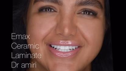 پوستر بهترین کامپوزیت ونیر در تهران