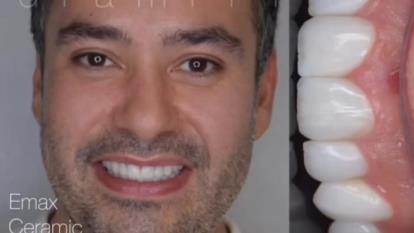 پوستر بهترین کامپوزیت ونیر در تهران