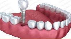 ایمپلنت بدون جراحی در ساری