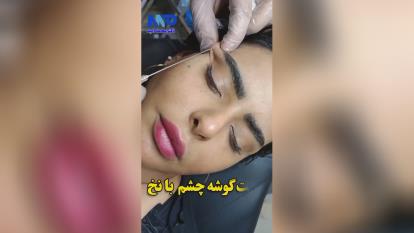 پوستر اندولیفت دد تهران