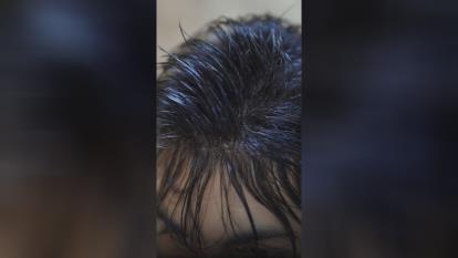 پوستر پروتز مو طبیعی بدون‌ چسب