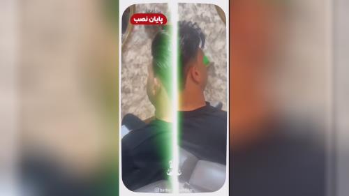 پروتز مو طبیعی بدون چسب