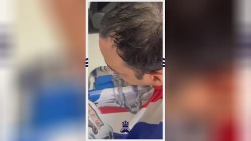 پروتز مو طبیعی بدون چسب