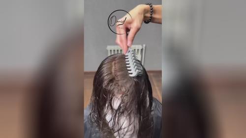 کاشت مو زنانه در اصفهان 