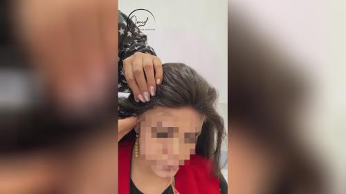 کاشت مو زنانه در اصفهان 