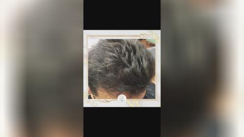 کلینیک تخصصی کاشت مو در شیراز