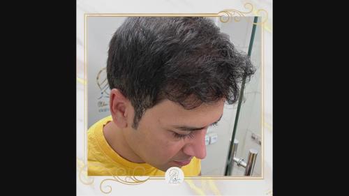 متخصص کاشت مو در شیراز