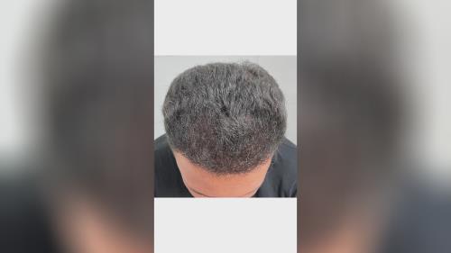 کلینیک تخصصی کاشت مو در شیراز