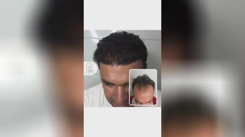 کلینیک تخصصی کاشت مو در شیراز