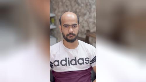 پروتز مو طبیعی بدون چسب