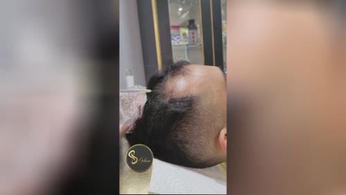 بهترین مزوتراپی در تهران کجاست؟