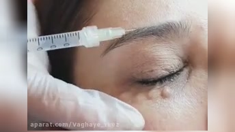 بهترین مزوتراپی در تهران کجاست؟