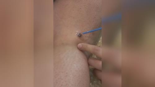 درمان قطعی زگیل تناسلی خرم اباد