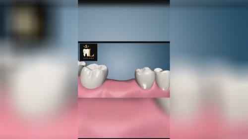 بهترین مرکز ایمپلنت تهران