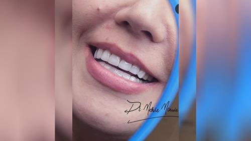 لمینت اقساطی تهران