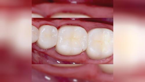 لمینت اقساطی تهران